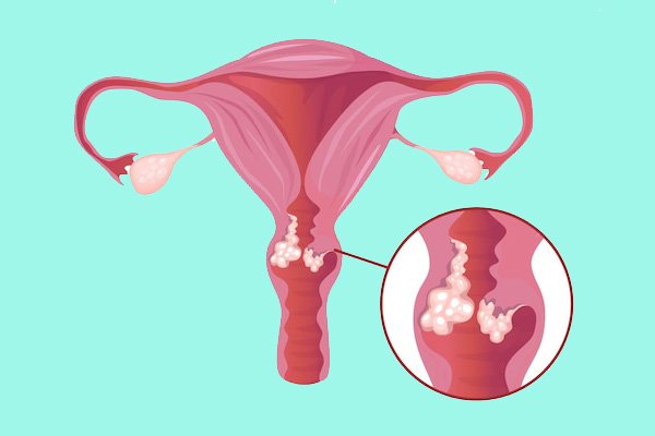Conditions We Treat - Cervical Cancer