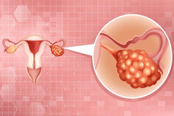Conditions We Treat - Ovarian Cancer