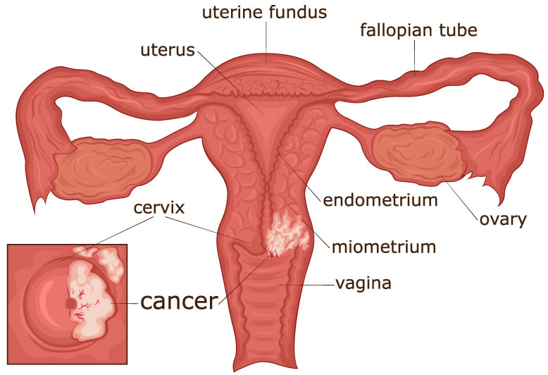 Cervical Cancer