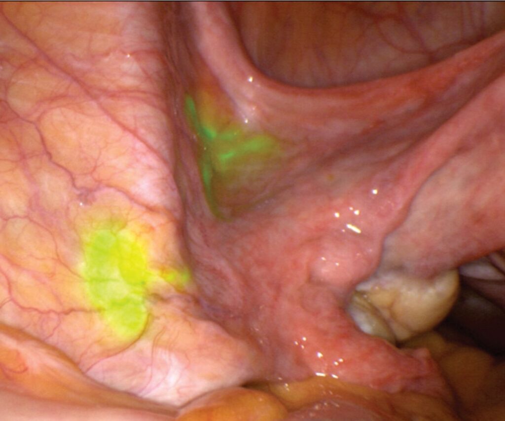Robotic Surgery in treatment of Gynecological Cancers