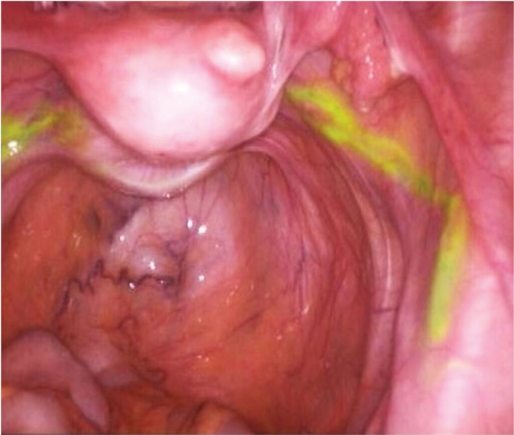 Robotic Surgery in treatment of Gynecological Cancers