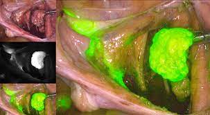 Robotic Surgery in treatment of Gynecological Cancers